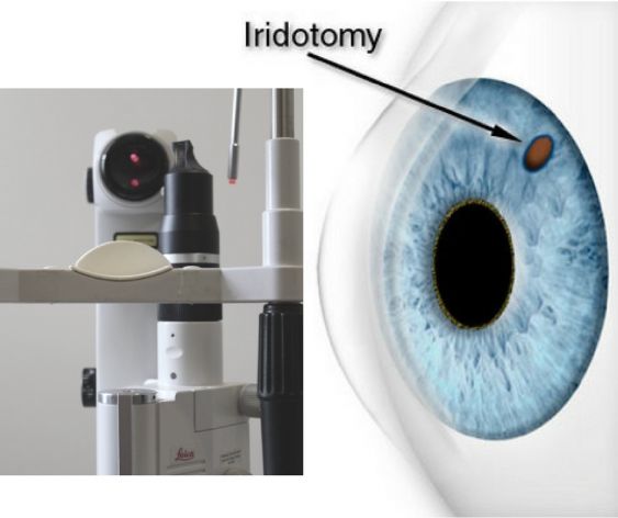 Iridotomia Yag Laser Tratamentos Instituto De Olhos De Colatina